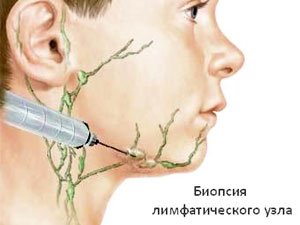 Схемы лечение лимфома ходжкина Схемы лечение лимфома ходжкина