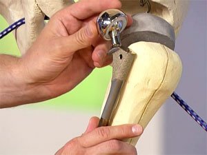 Эндопротезирование и полная замена сустава
