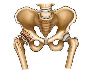 Схема лечения артроза тазобедренного сустава 2 степени