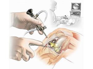 Стоимость артроскопии коленного сустава