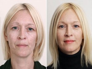 Отзывы Марины о процедуре омоложения