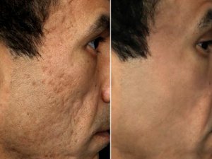 Отзывы о дермабразии лица