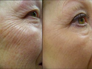 Отзывы Елены об алмазной дермабразии лица