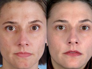 Отзывы о лазерной дермабразии лица