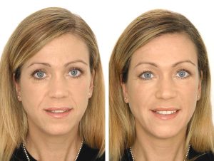 Пластика носогубных складок хирургическим путем до и после фото
