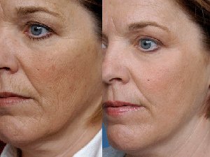 Екатерина, отзывы после дермабразии лица 