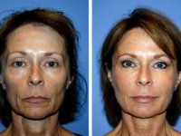 Что это такое биорепарация?