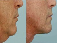 Липосакция второго подбородка