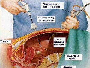Лапароскопия миомы матки