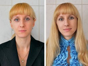 Отзывы о хейлопластике