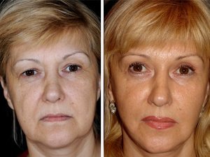 Отзывы Вероники после хейлопластики