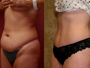 Отзывы о пластике живота