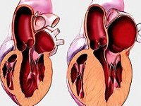 Как лечить гипертрофию левого желудочка