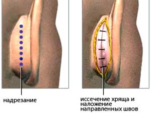 Отопластика: из чего складывается стоимость
