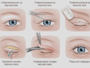 Схемы выполнения блефаропластики