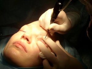 Трансконъюнктивальная блефаропластика в процессе