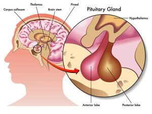 Лечение кисты гипофиза