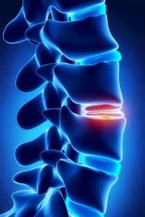 Что собой представляет искусственный межпозвоночный диск