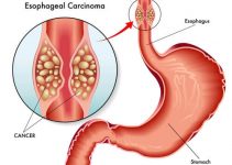 Рак пищевода