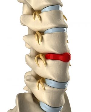 Лечение грыжи позвоночника в Германии