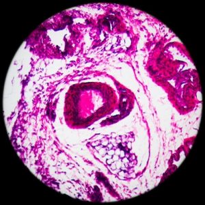 Лечение лимфомы в Германии