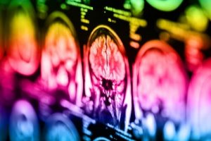 Лечение глиомы в Германии