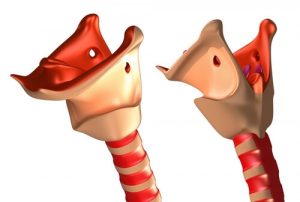 Лечение рака гортани в Германии