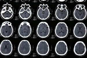 Операции на головном мозге в Израиле