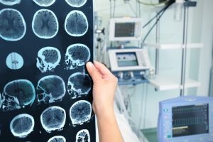 Операции на головном мозге в Израиле