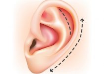 Отопластика в Израиле