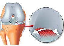 Разрыв сухожилия