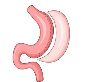 iшунтирование желудка