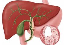 холангиокарцинома