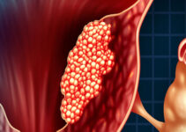 хориокарцинома