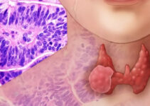 Лечение медуллярного рака в Израиле