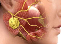 Лечение аденокистозного рака в Израиле